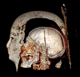 Ancient Eguptian mummy as imaged with CT scanner. Credit: Dr. Michael Miyamoto